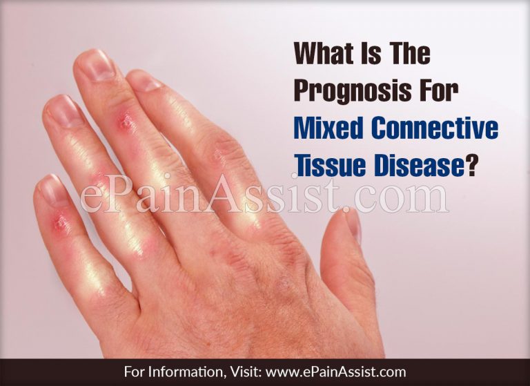 What Is The Treatment For Mixed Connective Tissue Disorder?