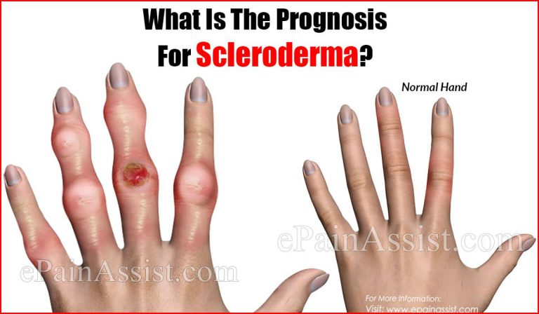 What Is The Prognosis For Scleroderma?