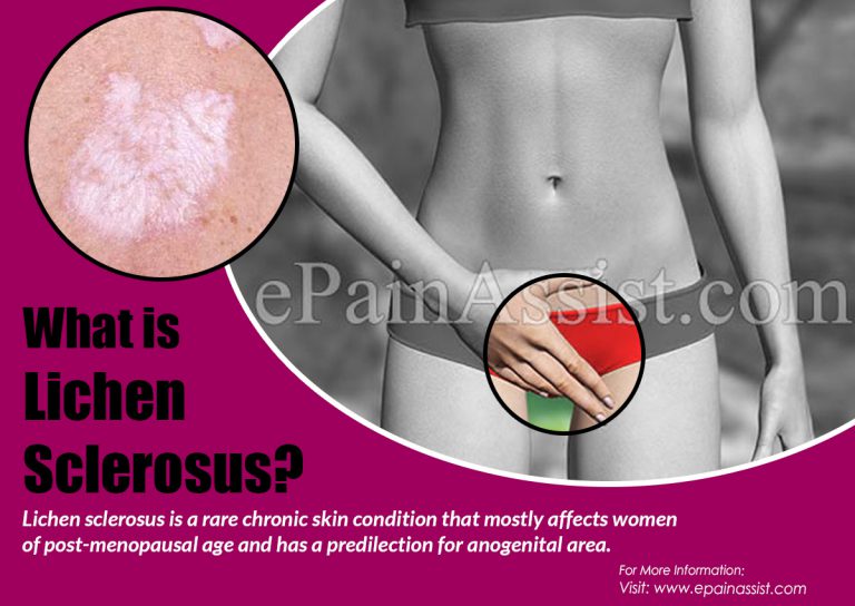 Are Lichen Sclerosus and Lichen Planus Related?