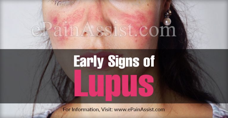 Early Signs of Lupus