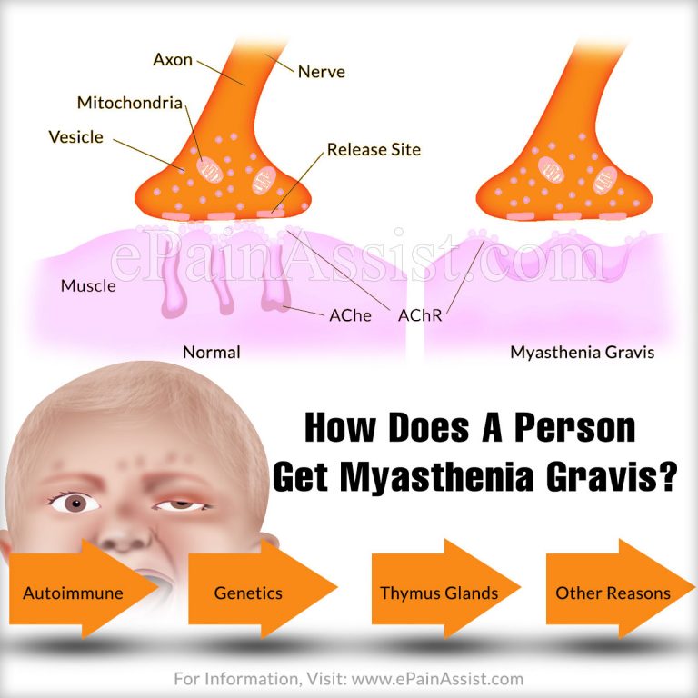 How Does A Person Get Myasthenia Gravis?