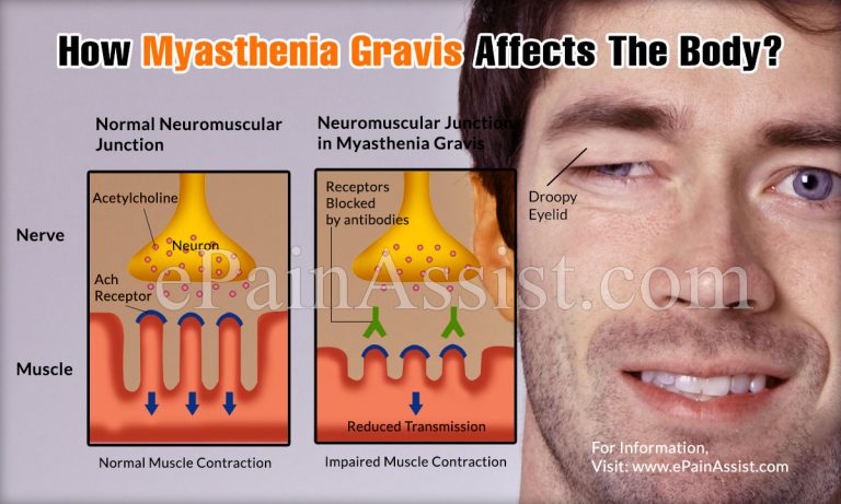 How Myasthenia Gravis Affects The Body?