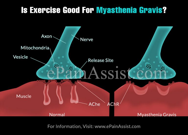 Is Exercise Good For Myasthenia Gravis? What Are The Best Exercises?