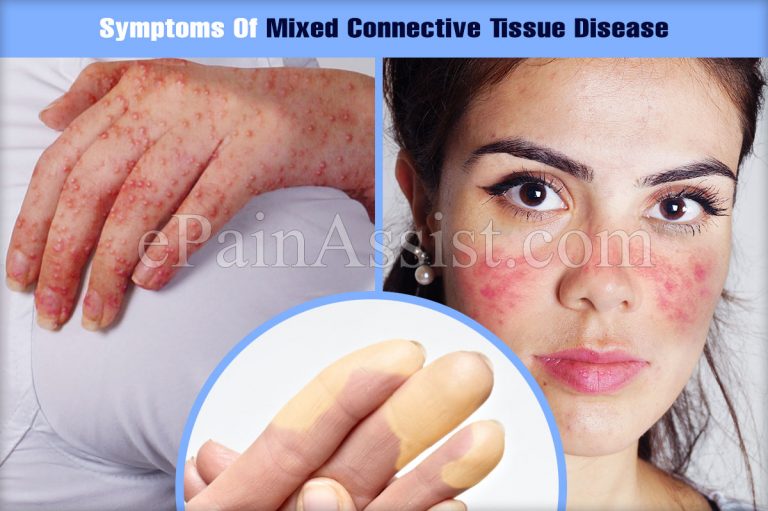 What Are The Symptoms Of Mixed Connective Tissue Disease?