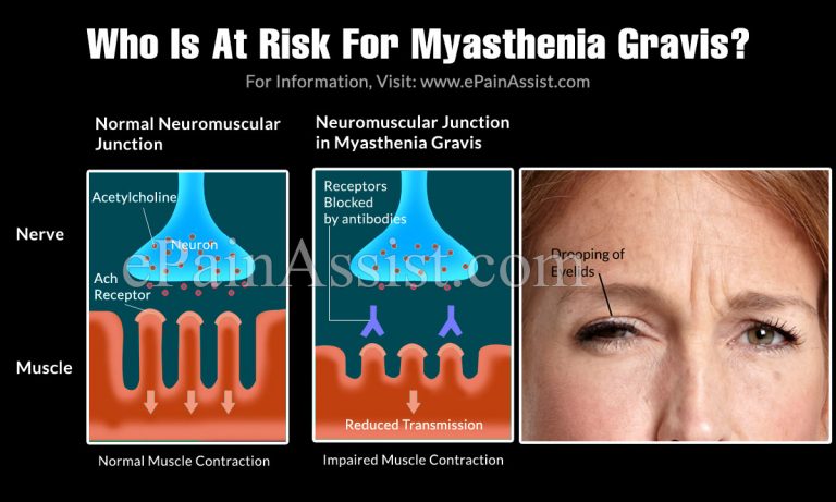 Who Is At Risk For Myasthenia Gravis & When Will The Symptoms Worsen?