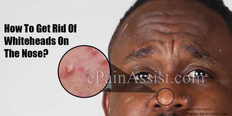 How To Get Rid Of Whiteheads On The Nose?