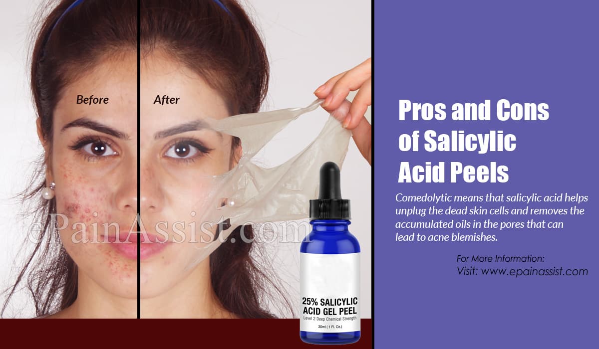 Pros and Cons of Salicylic Acid Peels