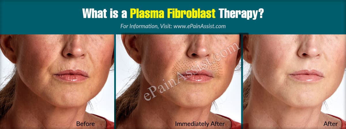 What is a Plasma Fibroblast Therapy? What is a Plasma Fibroblast Therapy?