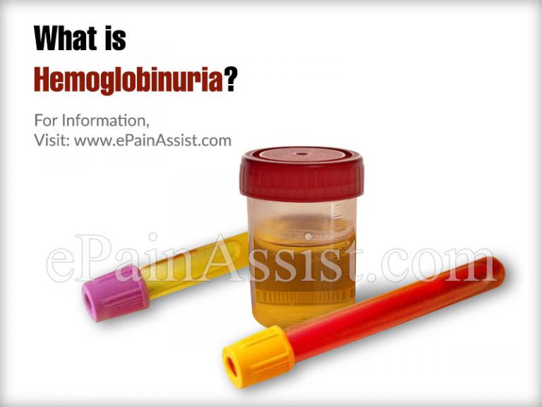 Hemoglobinuria: Causes, Symptoms, Treatment, Diagnosis
