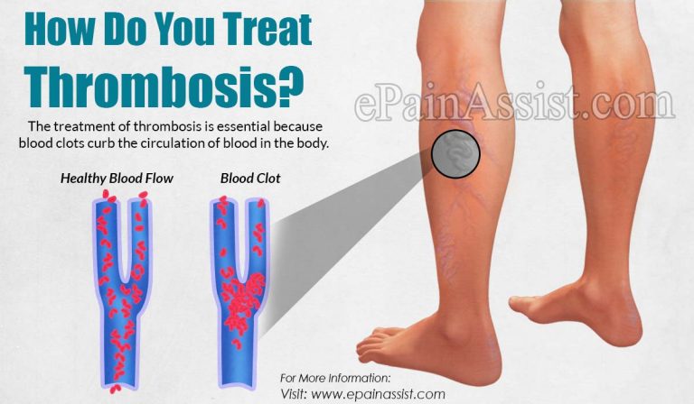 How Do You Treat Thrombosis?