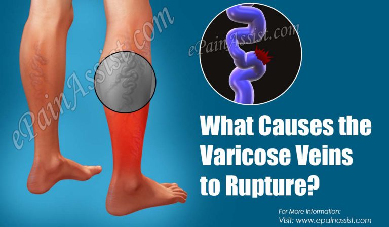 What Causes the Varicose Veins to Rupture & How is it Treated?
