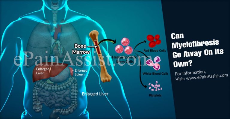 Can Myelofibrosis Go Away On Its Own?