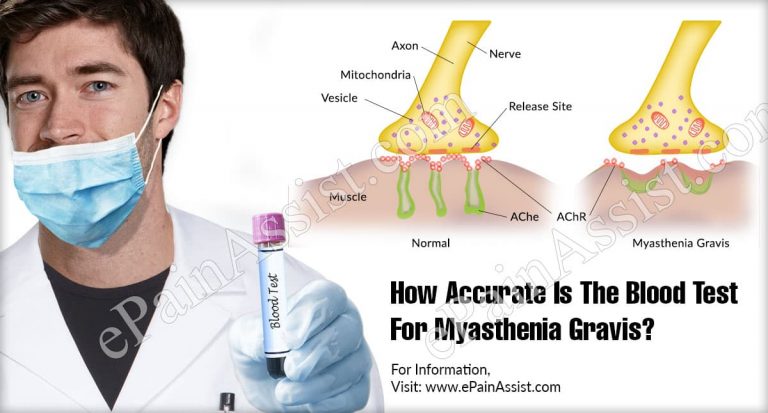 How Accurate Is The Blood Test For Myasthenia Gravis?