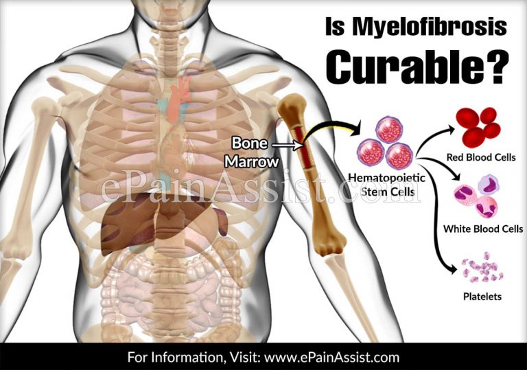 Is Myelofibrosis Curable & What Are The Treatment Options?