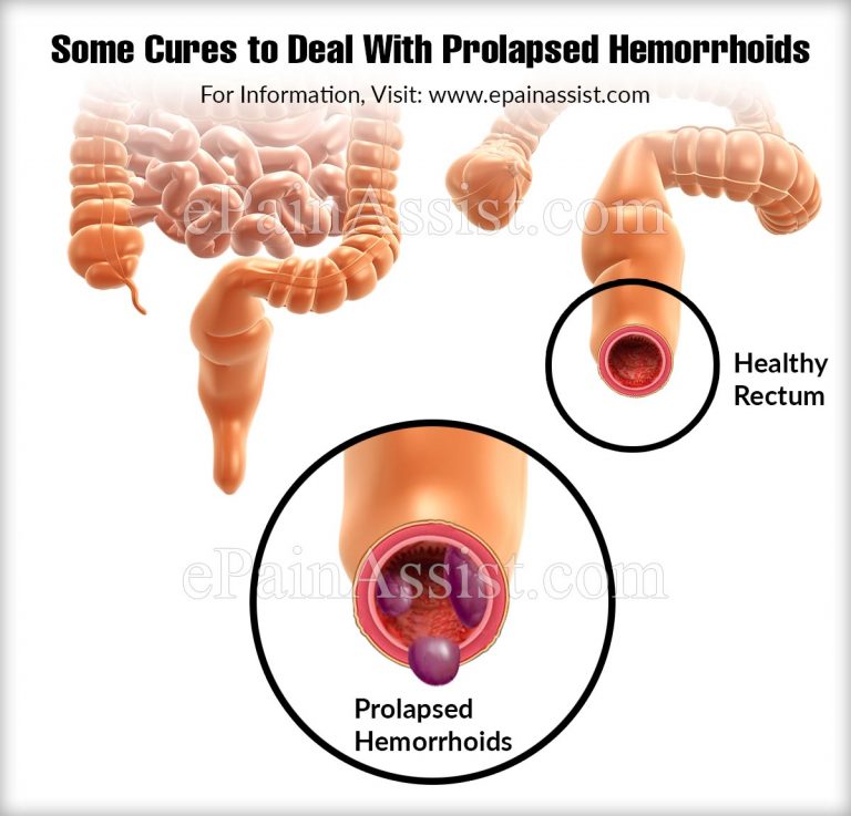 Some Cures to Deal With Prolapsed Hemorrhoids