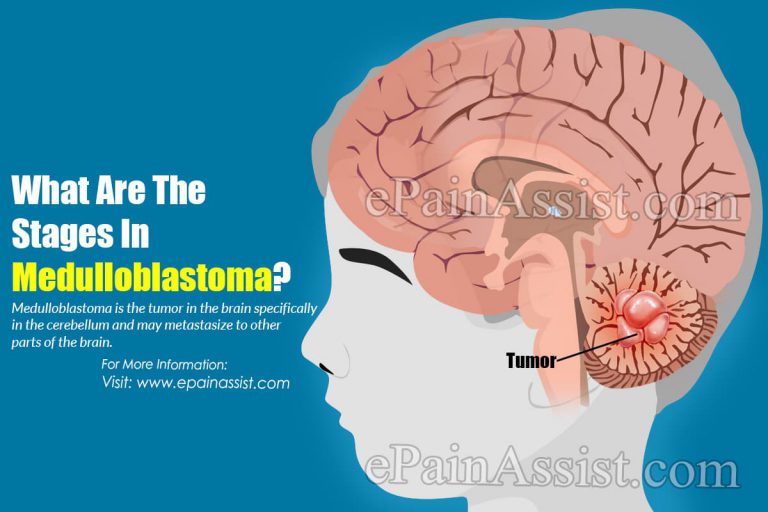 What Are The Stages In Medulloblastoma?