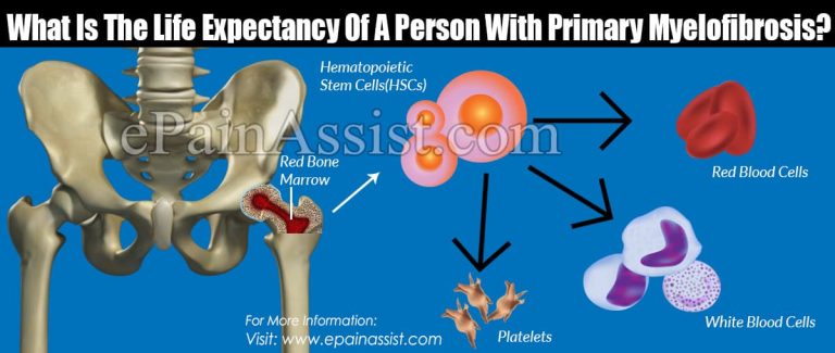 What Is The Life Expectancy Of A Person With Primary Myelofibrosis?