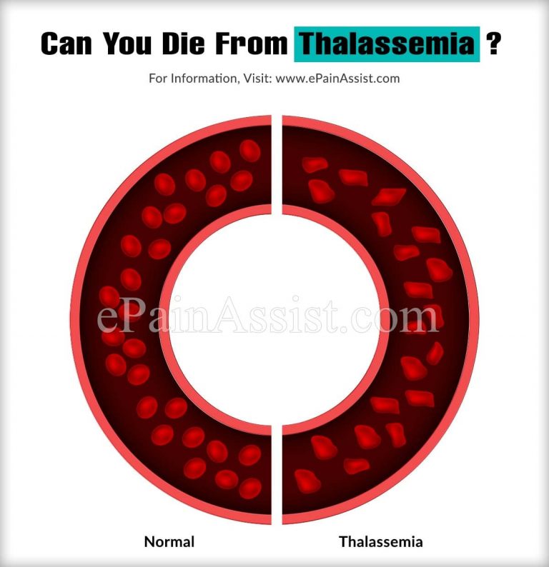 Can You Die From Thalassemia?