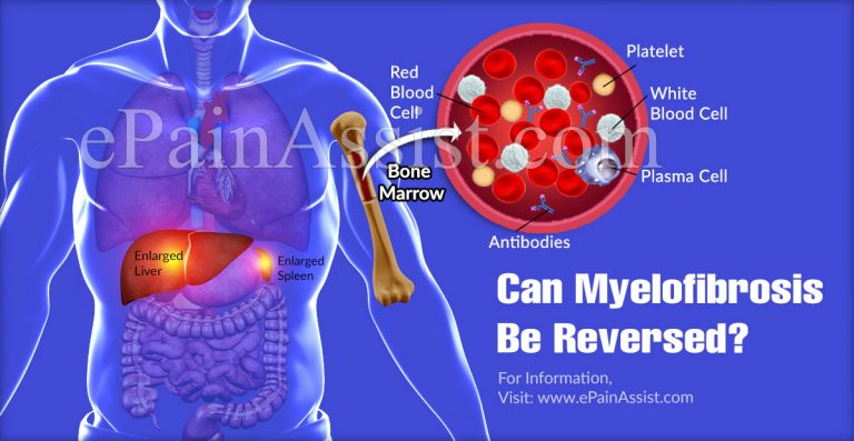 Can Myelofibrosis Be Reversed?