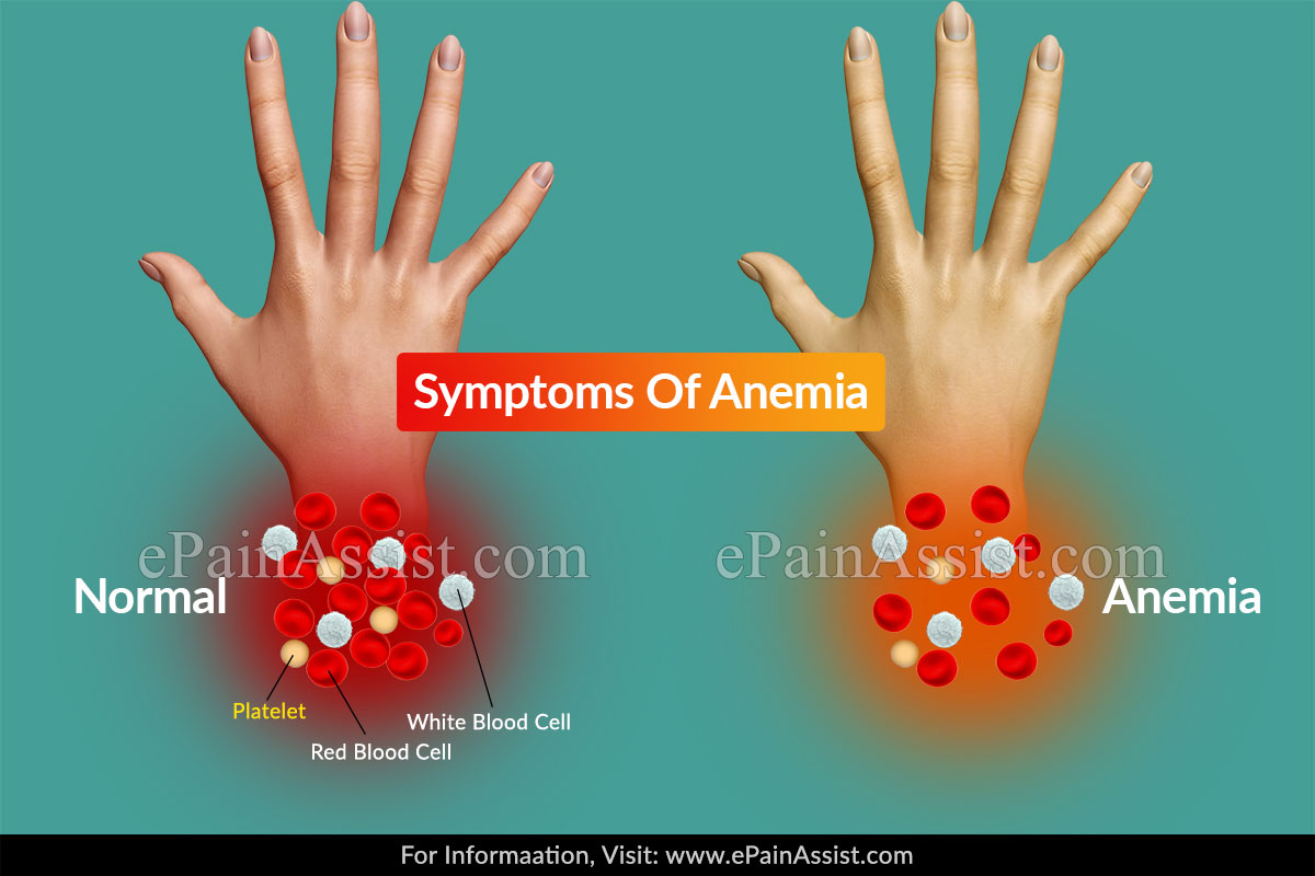 Symptoms of Anemia 