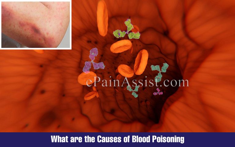 Blood Poisoning: Causes, Symptoms, Treatment, Prognosis, Prevention, Diagnosis