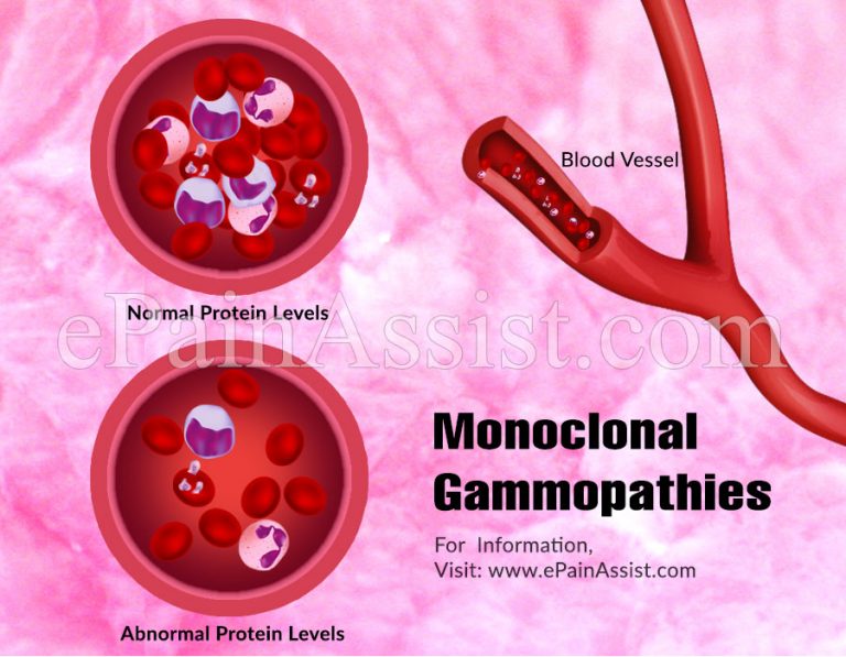 What Is Monoclonal Gammopathy of Undetermined Significance (MGUS)?
