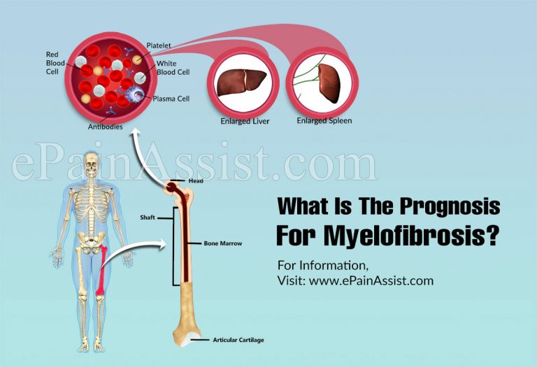 What Is The Prognosis For Myelofibrosis?