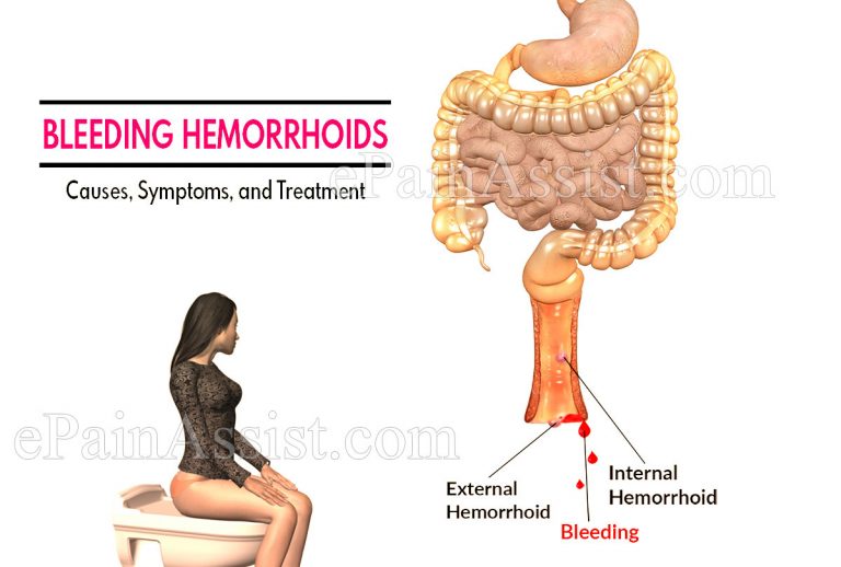 Bleeding Hemorrhoids: Causes, Symptoms, and Treatment