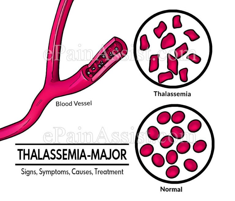 Thalassemia Major: Signs, Symptoms, Causes, Treatment, Complications, Diagnosis, Nutritional Support