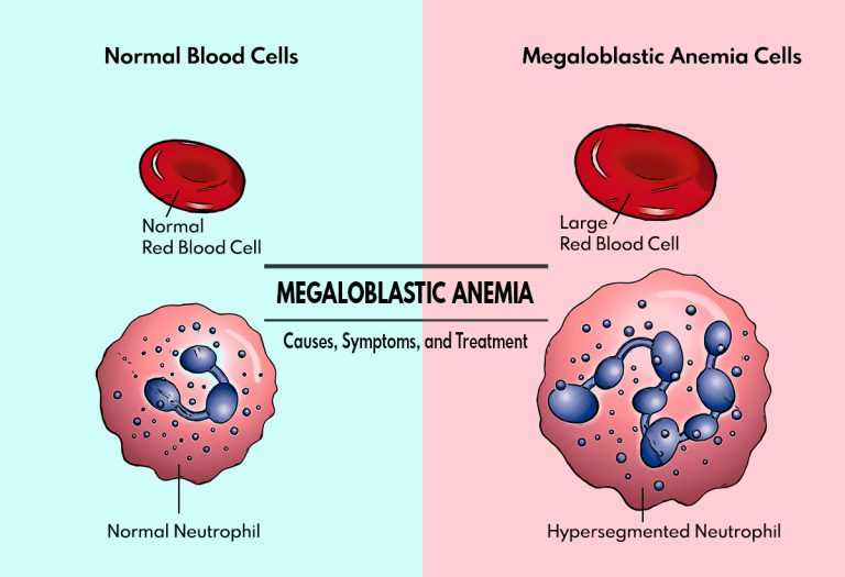 Understanding Megaloblastic Anemia – Causes, Symptoms, and Treatment