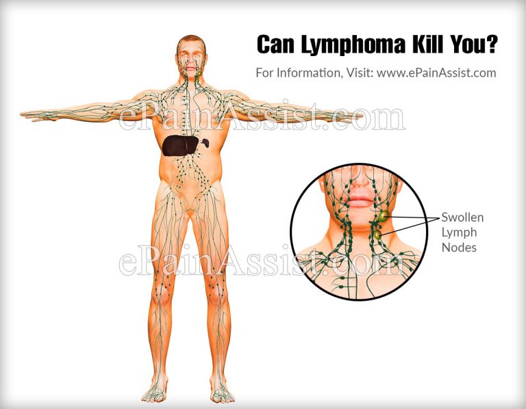 Can Lymphoma Kill You?