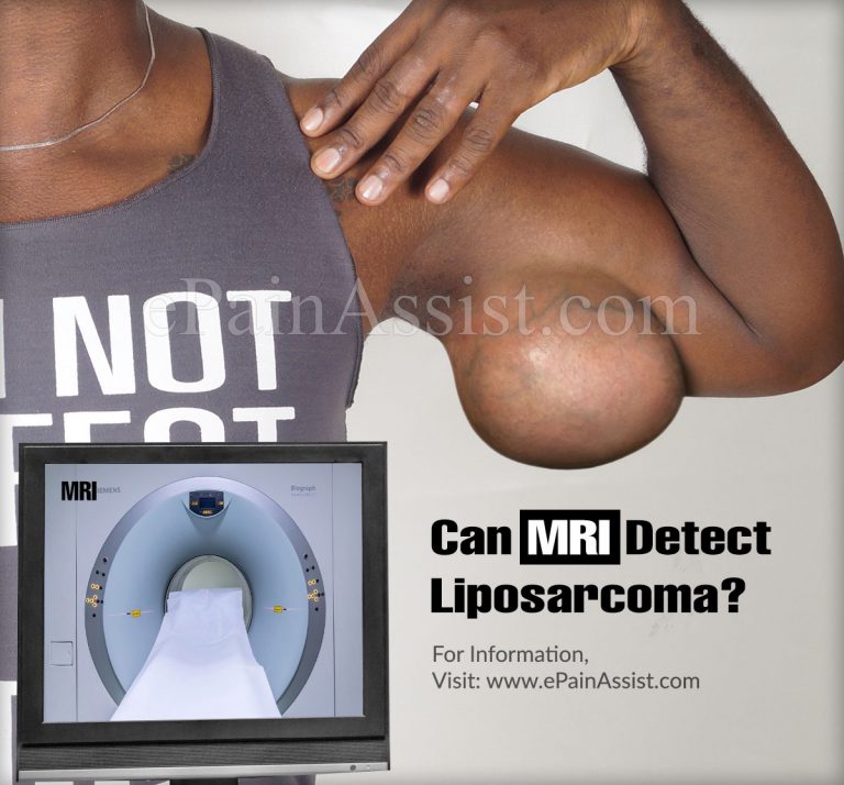 Can MRI Detect Liposarcoma?