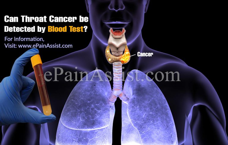 Can Throat Cancer Be detected By Blood Test & Is Cancer in Throat Deadly?