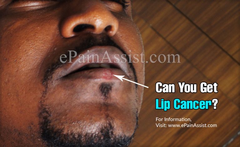 Can You Get Lip Cancer?