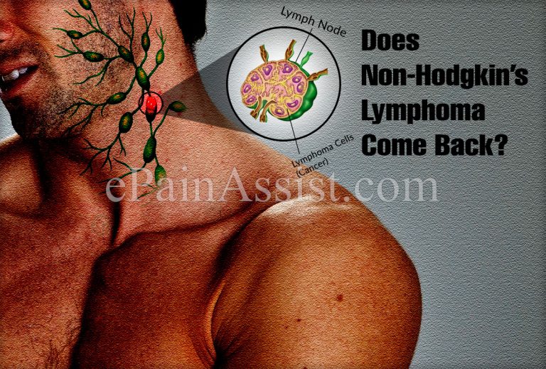 Does Non-Hodgkin’s Lymphoma Come Back?