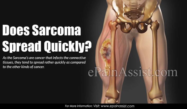 Does Sarcoma Spread Quickly?