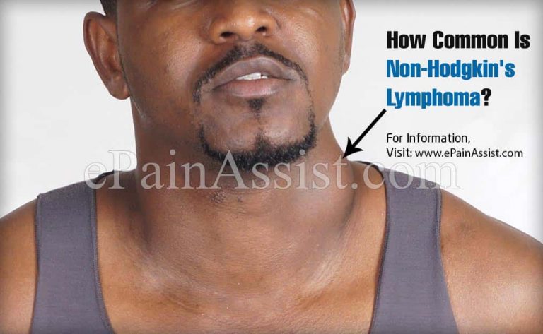 How Common Is Non-Hodgkin’s Lymphoma?
