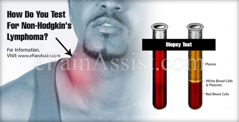 How Do You Test For Non-Hodgkin’s Lymphoma?