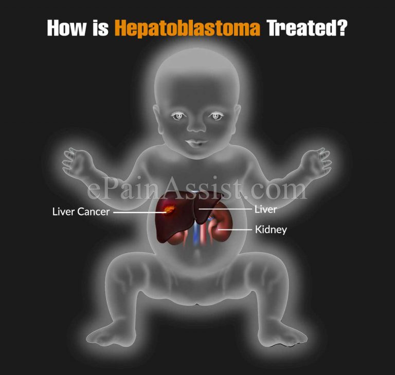 How is Hepatoblastoma Treated, Know the Survival Rate, Stages, Risk Factors, Causes, Symptoms, Pathophysiology of  Hepatoblastoma