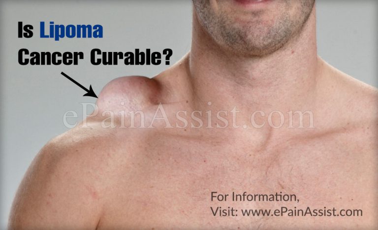 Is Lipoma Cancer Curable?