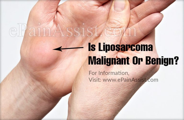 Is Liposarcoma Malignant Or Benign?