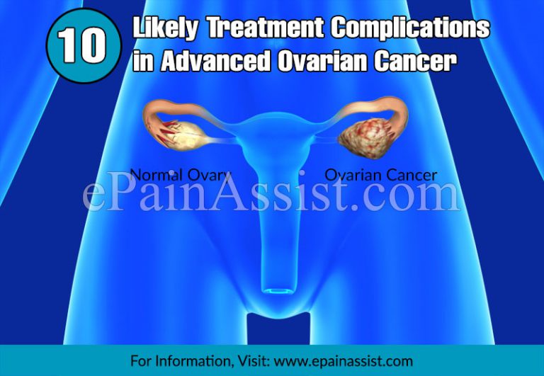 10 Likely Treatment Complications in Advanced Ovarian Cancer