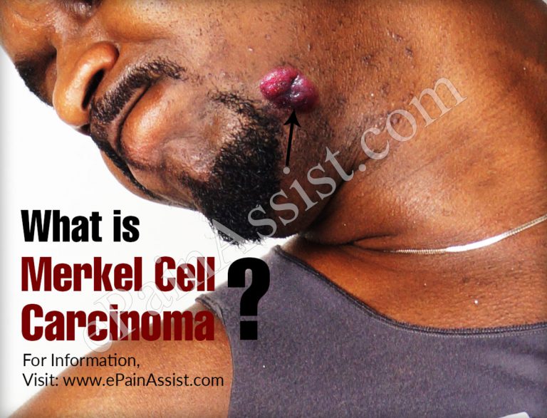 What is Merkel Cell Carcinoma (MCC), Causes, Symptoms, Treatment, Complications, Prevention
