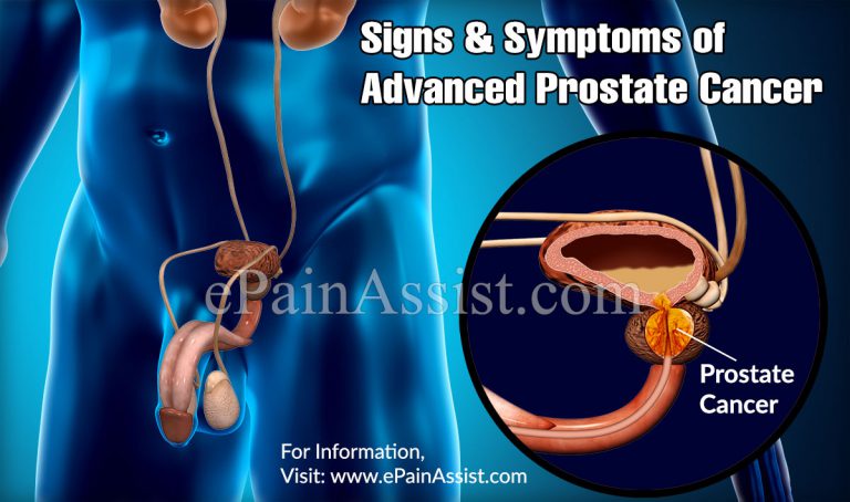 Signs & Symptoms of Advanced Prostate Cancer