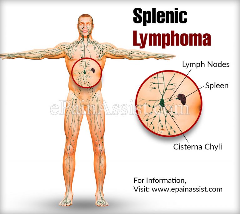 Splenic Lymphoma: Causes, Symptoms, Treatment, Prognosis