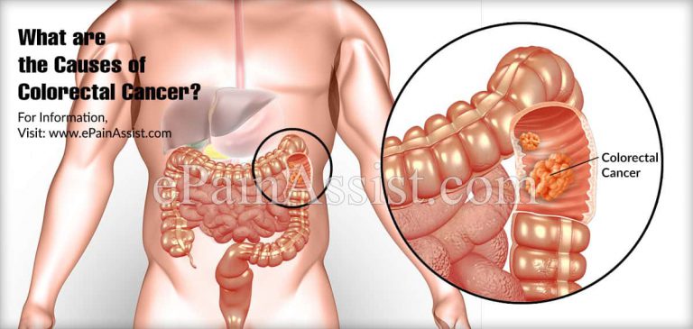 Stages of Colorectal Cancer & Its Treatment, Prognosis, Survival Rate, Causes, Symptoms, Risks