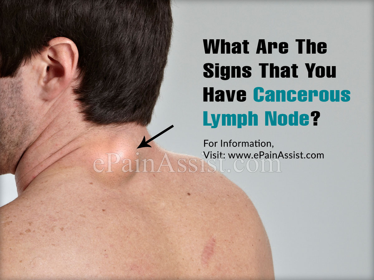 What Are The Signs That You Have Cancerous Lymph Node?