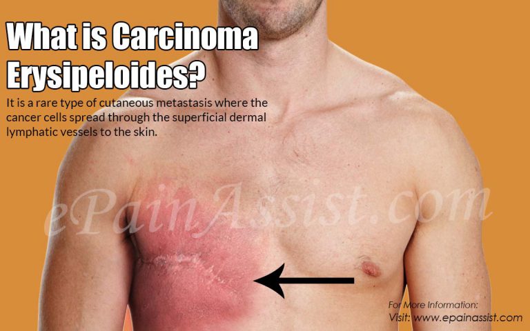 What is Carcinoma Erysipeloides & How is it Treated?|Causes, Symptoms, Life Expectancy, Prognosis of Carcinoma Erysipeloides