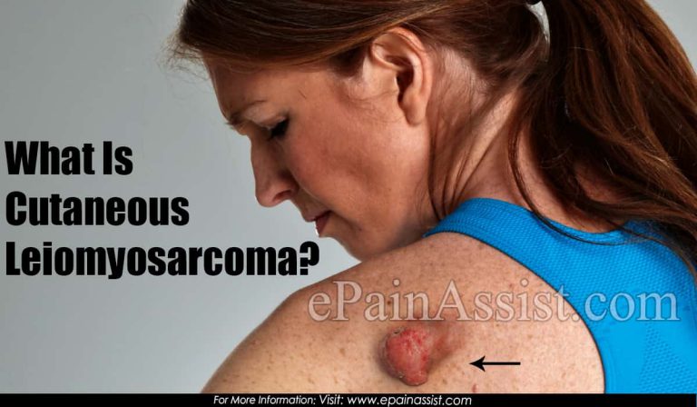 What Is Cutaneous Leiomyosarcoma?