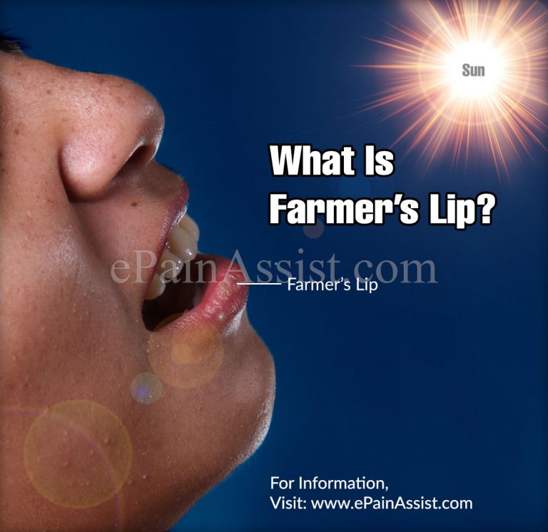 What Is Farmer’s Lip?